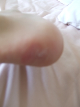 Blister